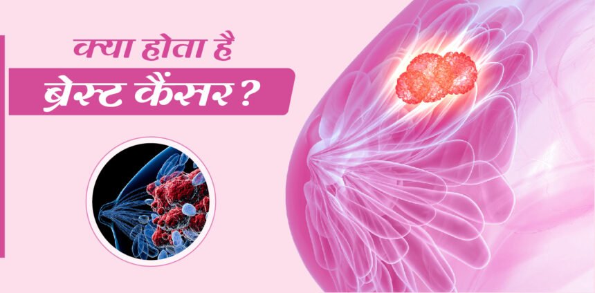 स्तन कैंसर क्या है? (What Is Breast Cancer?)